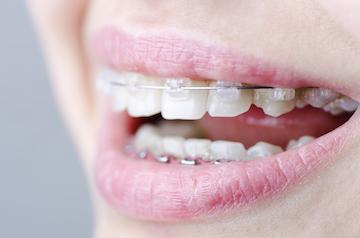 An image of braces in Erina